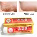 Крем для лечения  трещин и лишая на пятках, руках и ногах Yiganerjing 